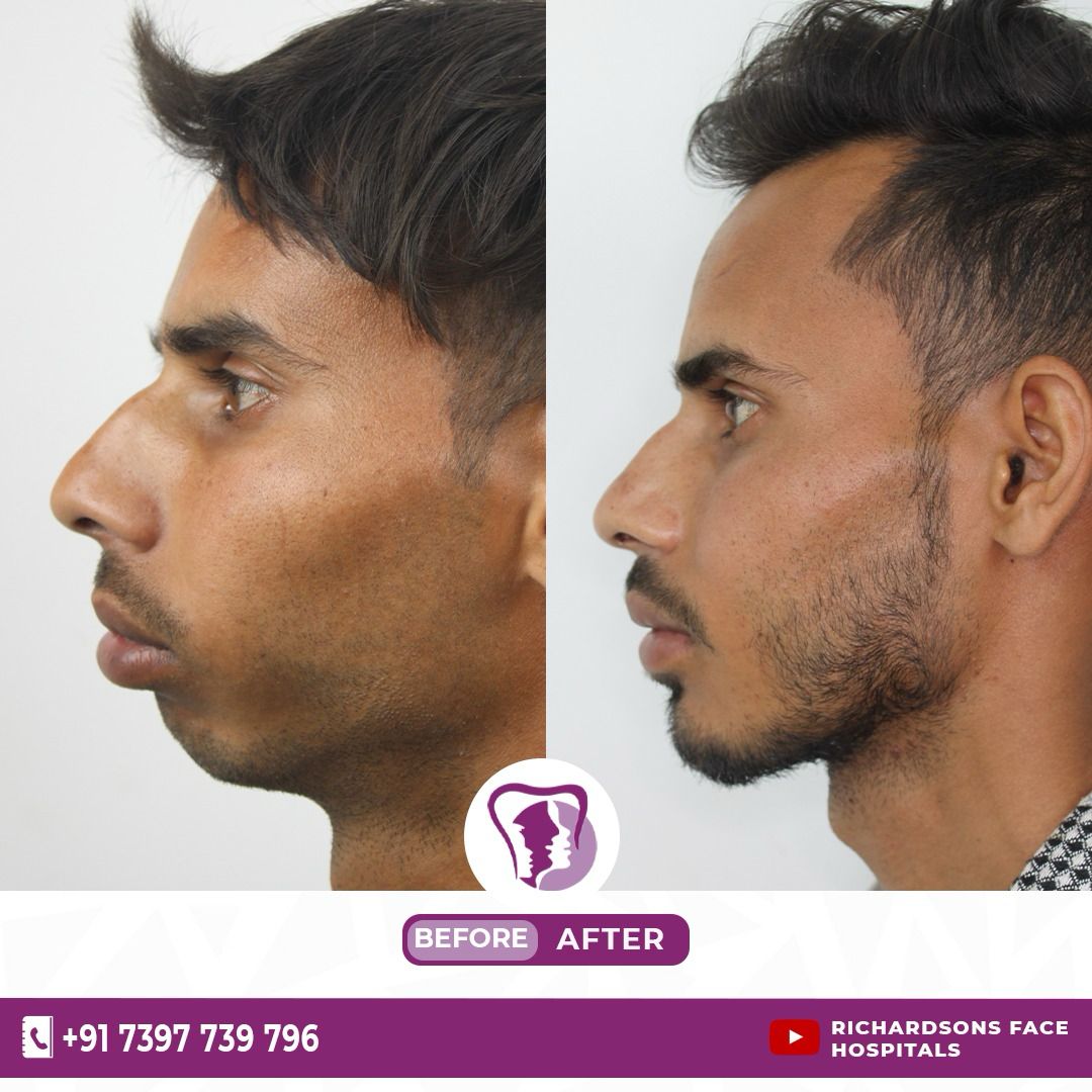Jaw Contouring surgery