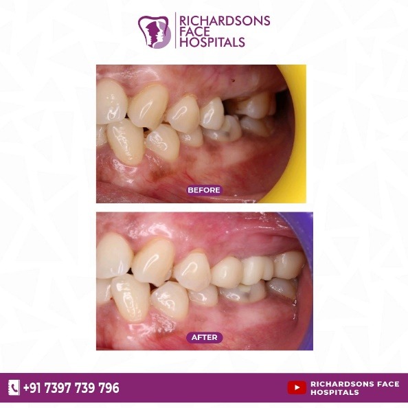 Dental Implants Vs Bridges