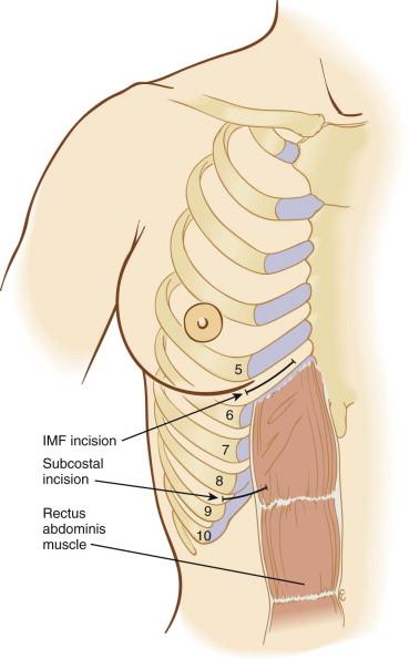 role of rib graft in rhinoplasty