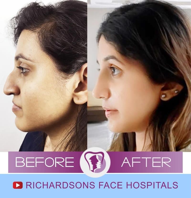role of rib graft in rhinoplasty