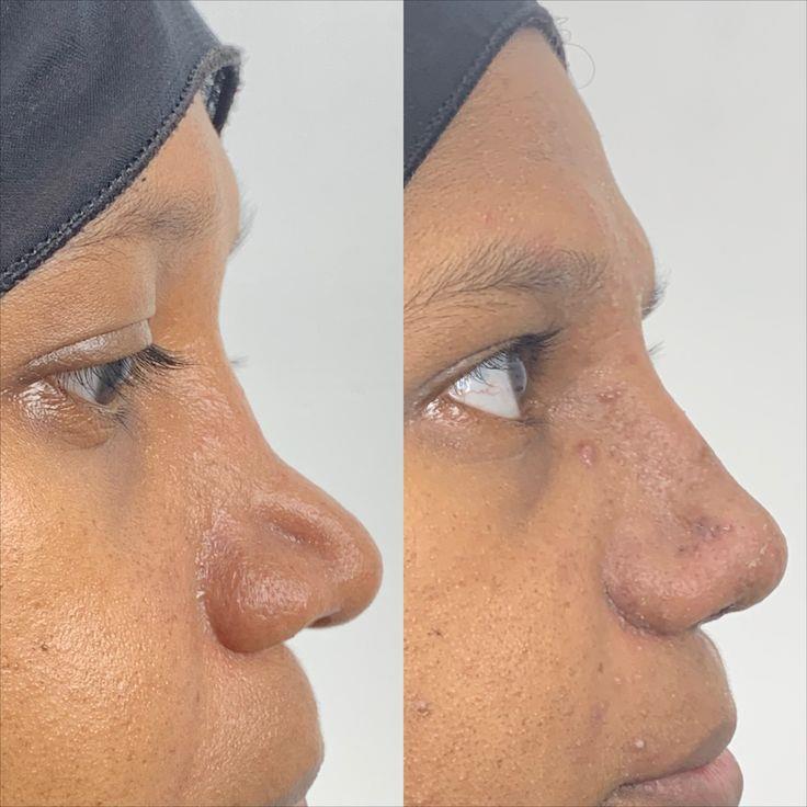 role of rib graft in rhinoplasty