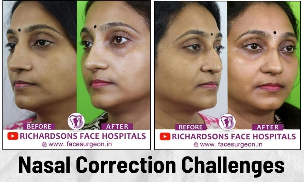 role of rib graft in rhinoplasty