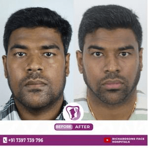 best snoring treatment in Bangalore
