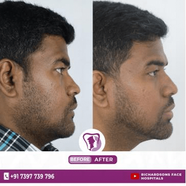 best snoring treatment in Bangalore