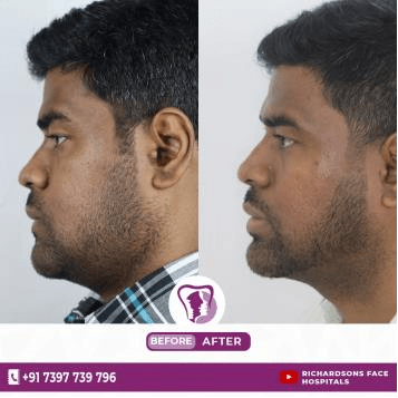 best snoring treatment in Bangalore