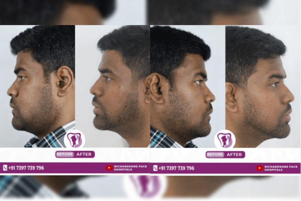 Best Snoring Treatment in Bangalore