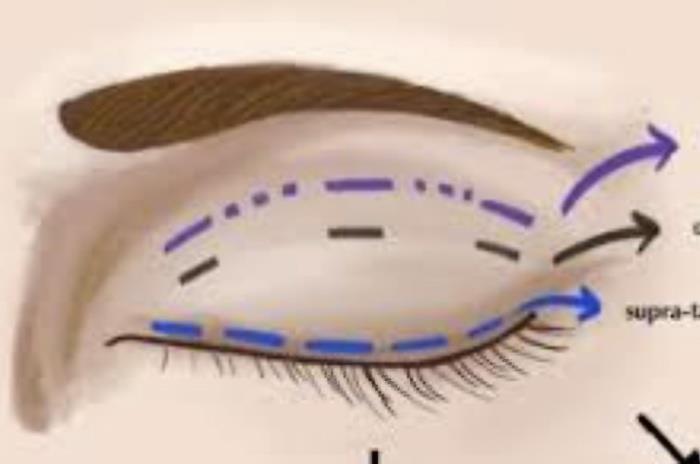 Blepharoplasty.pdf image 000