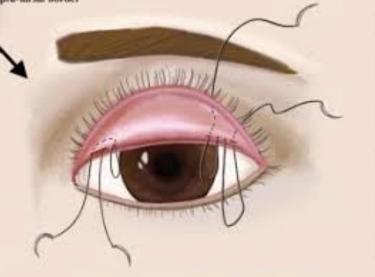 Blepharoplasty.pdf image 001