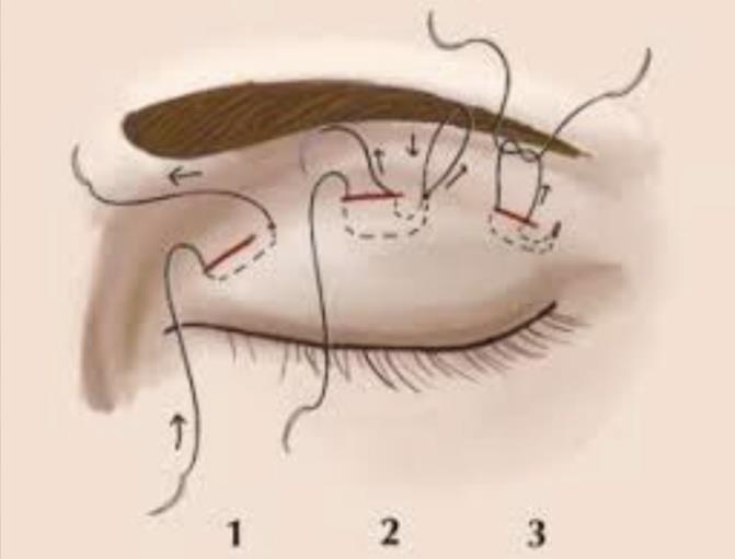 Blepharoplasty.pdf image 002