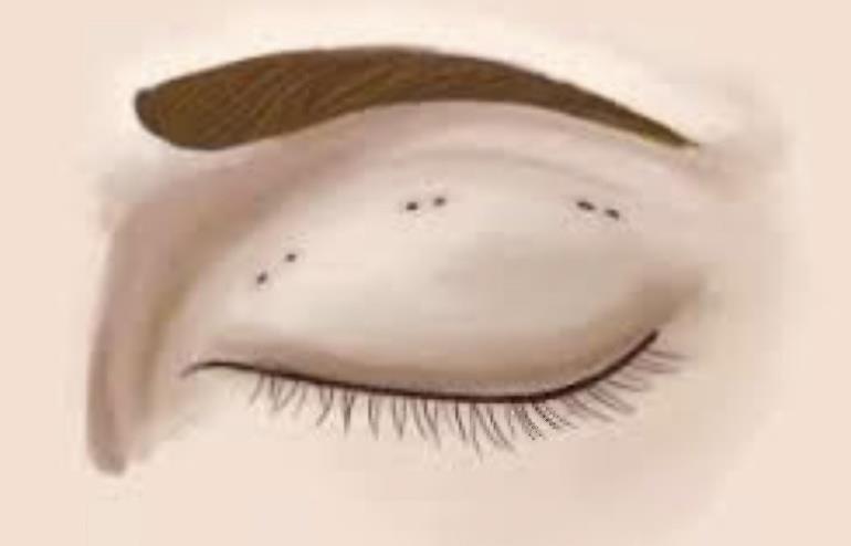 Blepharoplasty.pdf image 003