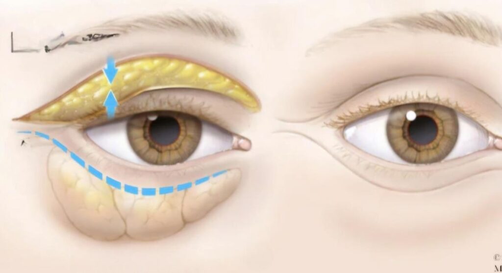 Blepharoplasty.pdf image 004