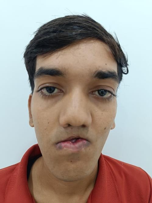 Cleft Maxillary Hypoplasia