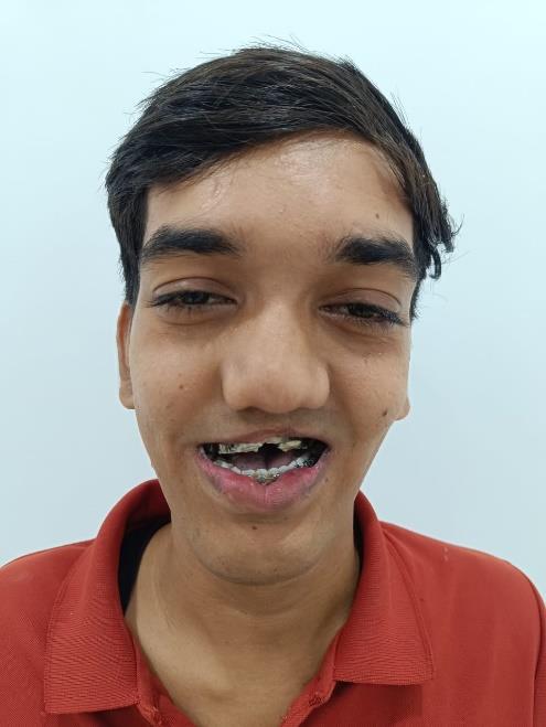 Cleft Maxillary Hypoplasia