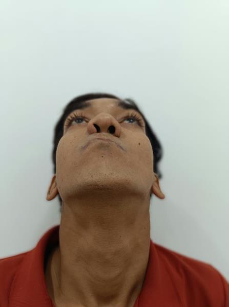 Cleft Maxillary Hypoplasia