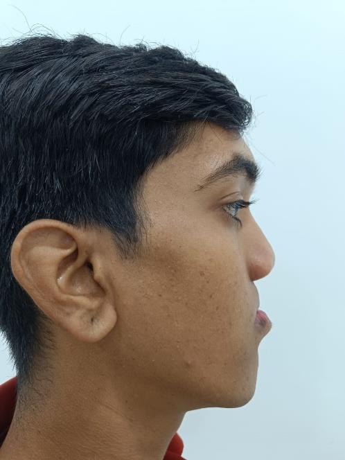 Cleft Maxillary Hypoplasia