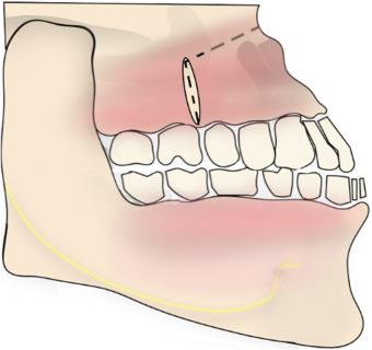 Cleft Maxillary Hypoplasia