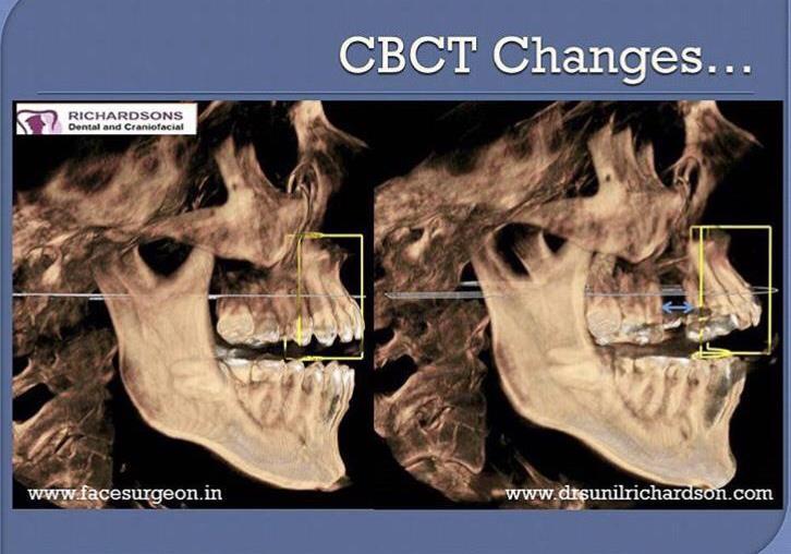 Cleft Maxillary Hypoplasia
