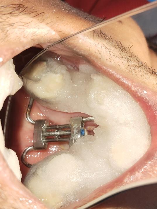 Cleft Maxillary Hypoplasia