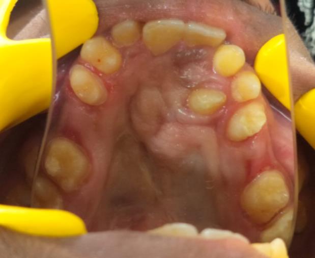 Cleft Maxillary Hypoplasia