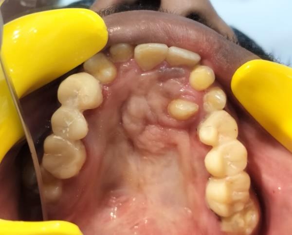 Cleft Maxillary Hypoplasia