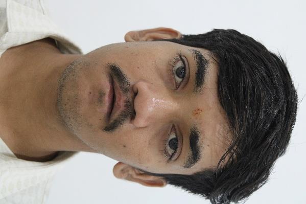 Cleft Maxillary Hypoplasia