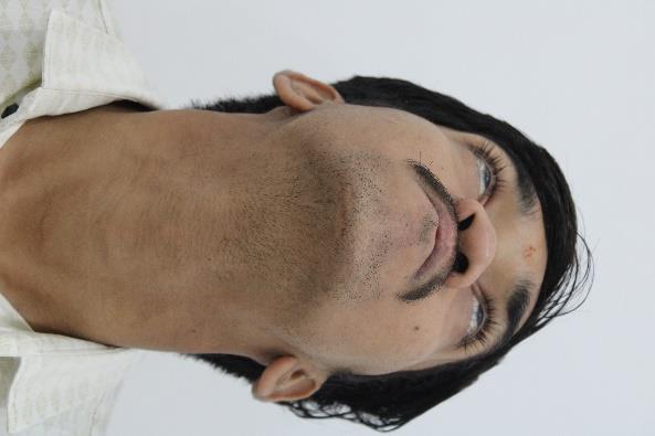 Cleft Maxillary Hypoplasia