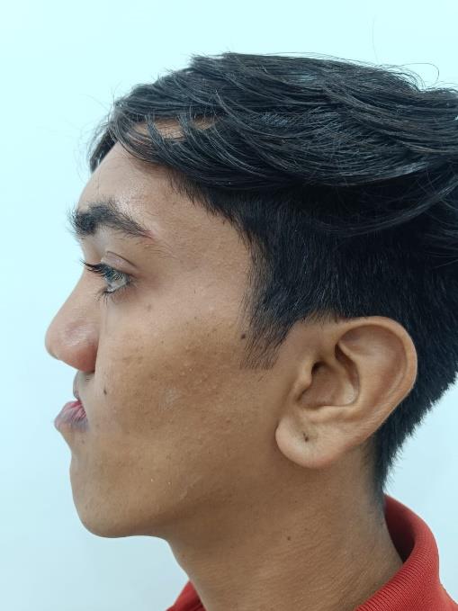 Cleft Maxillary Hypoplasia
