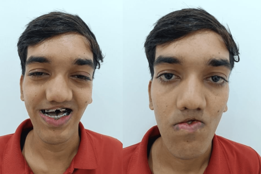 Cleft Maxillary Hypoplasia