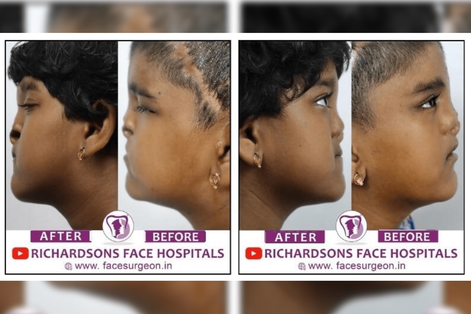 Understanding Tessier Clefts