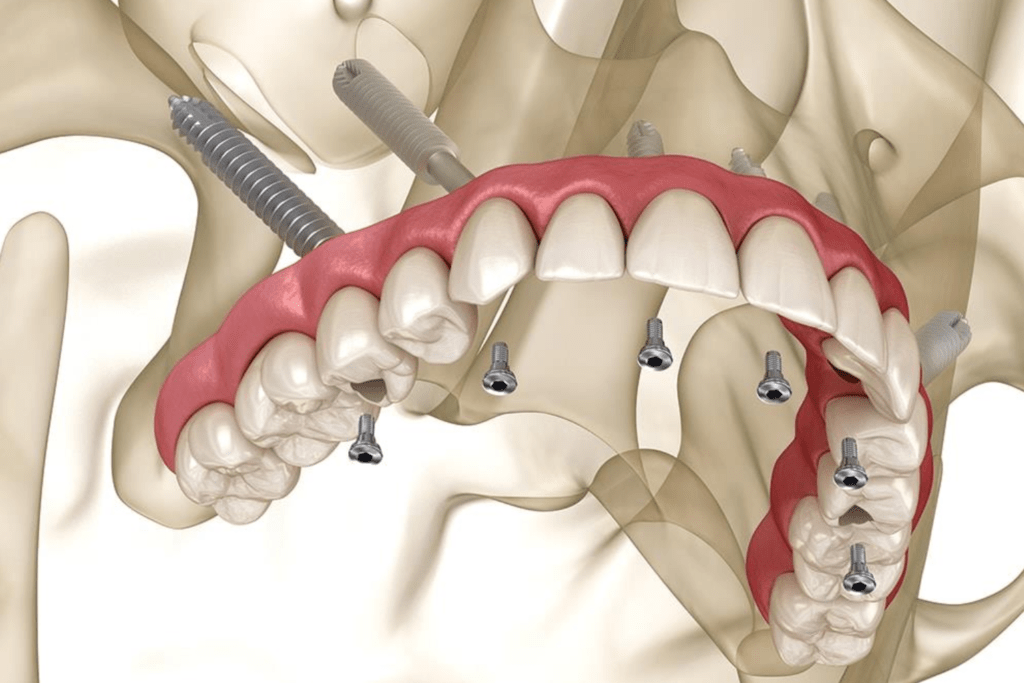 Zygomatic Implants