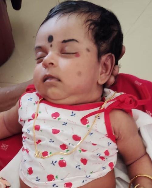 best Haemangiomas treatment in Bangalore