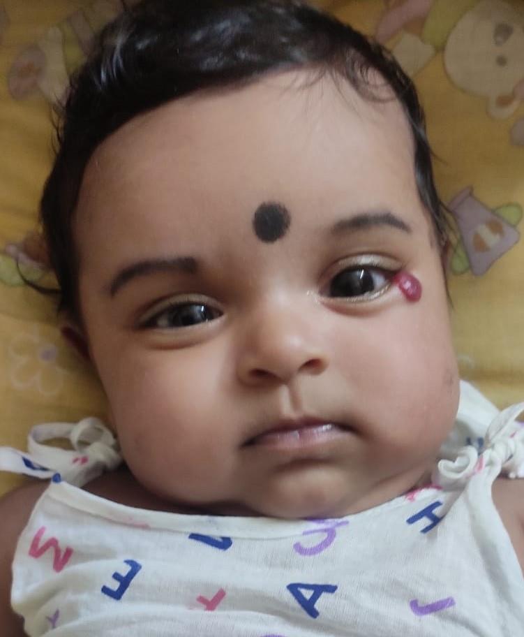 best Haemangiomas treatment in Bangalore