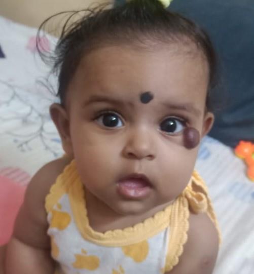 best Haemangiomas treatment in Bangalore