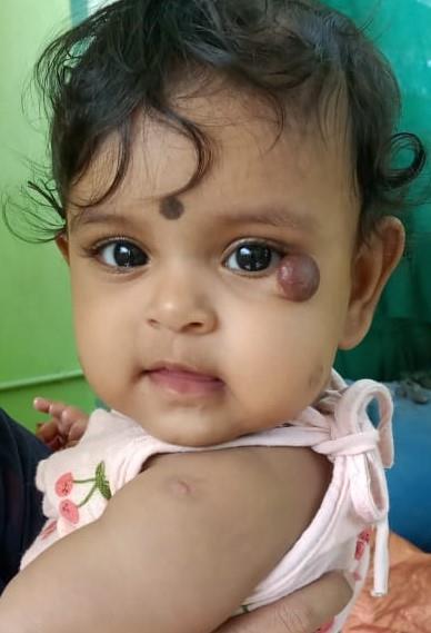 best Haemangiomas treatment in Bangalore