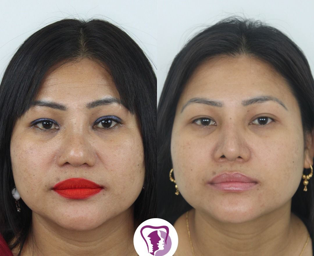 Best Rhinoplasty Treatment In Bangalore, India