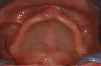 Best Zygomatic Implants in Bangalore