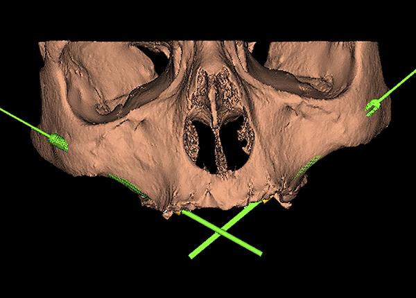 Best Zygomatic Implants in Bangalore