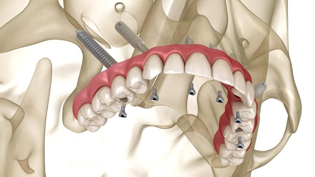 Best Zygomatic Implants in Bangalore