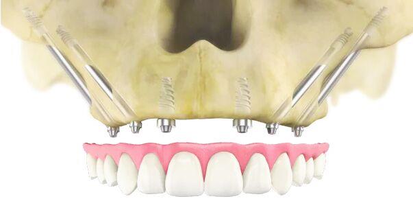 Best Zygomatic Implants in Bangalore