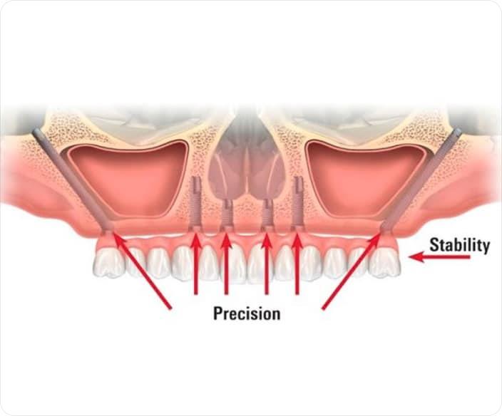 Best Zygomatic Implants in Bangalore