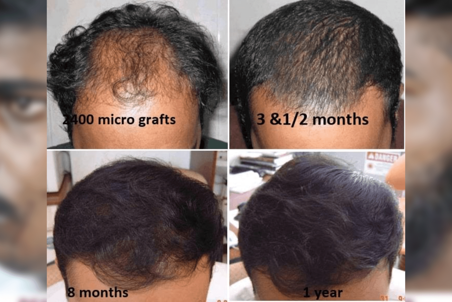 Best Hair & Beard Transplant