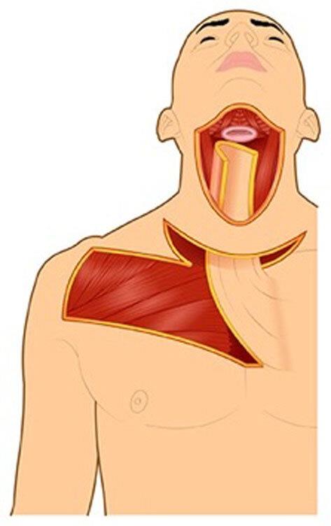 Trismus Correction Post Radiation Therapy.pdf image 002