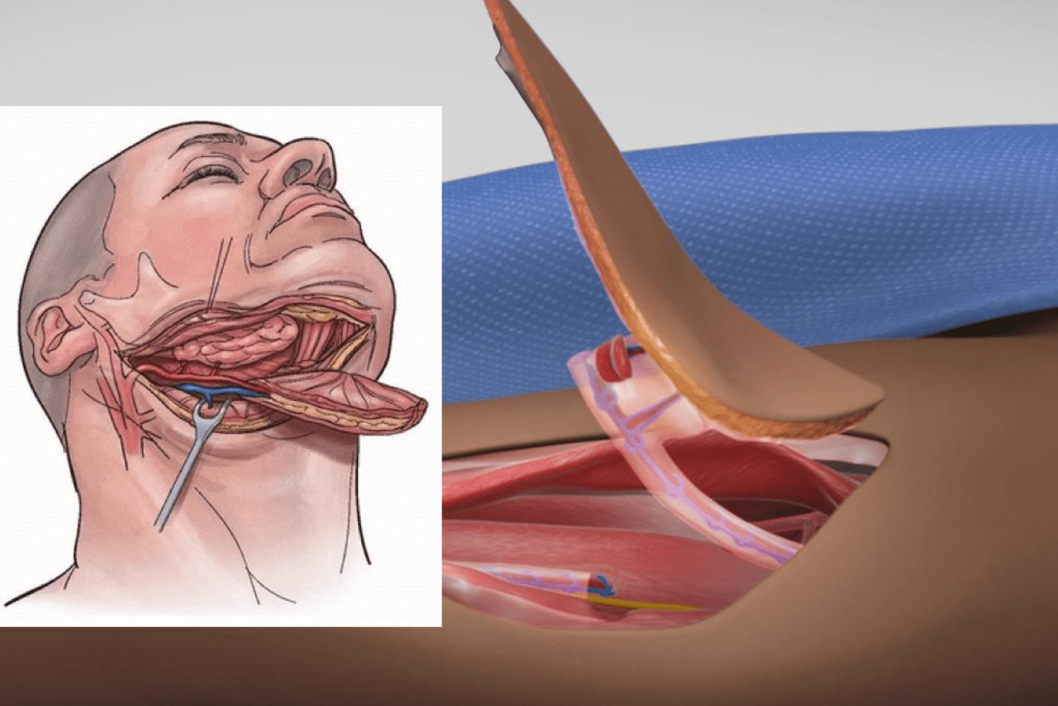 Trismus Correction