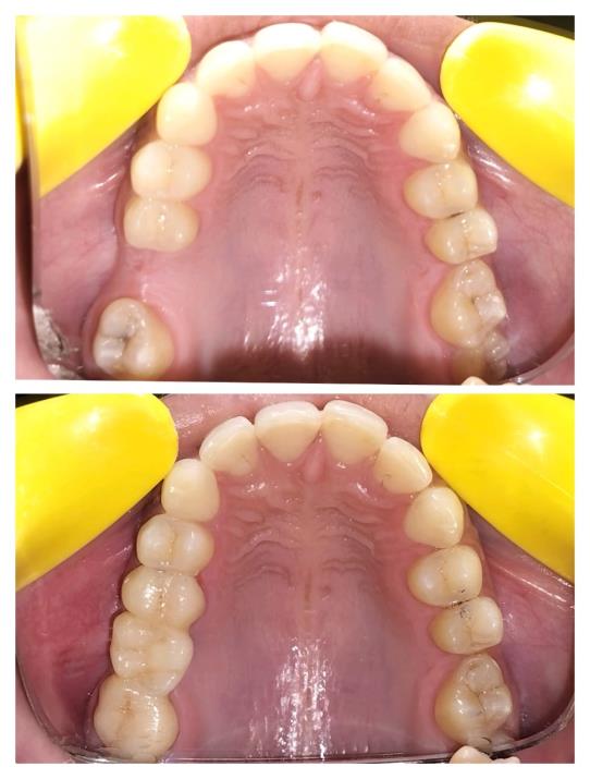 BEST TOOTH COLORED CROWNS USING CEREC PRIMESCAN AND PRIMEMILL.pdf image 000
