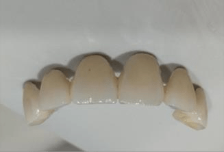 BEST TOOTH COLORED CROWNS USING CEREC PRIMESCAN AND PRIMEMILL.pdf image 023