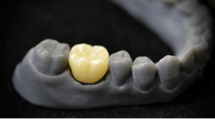 BEST TOOTH COLORED CROWNS USING CEREC PRIMESCAN AND PRIMEMILL.pdf image 025