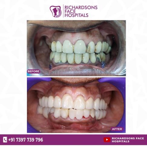 BEST TOOTH COLORED CROWNS USING CEREC PRIMESCAN AND PRIMEMILL.pdf image 027
