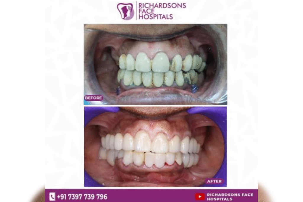 Best Tooth Colored Crowns