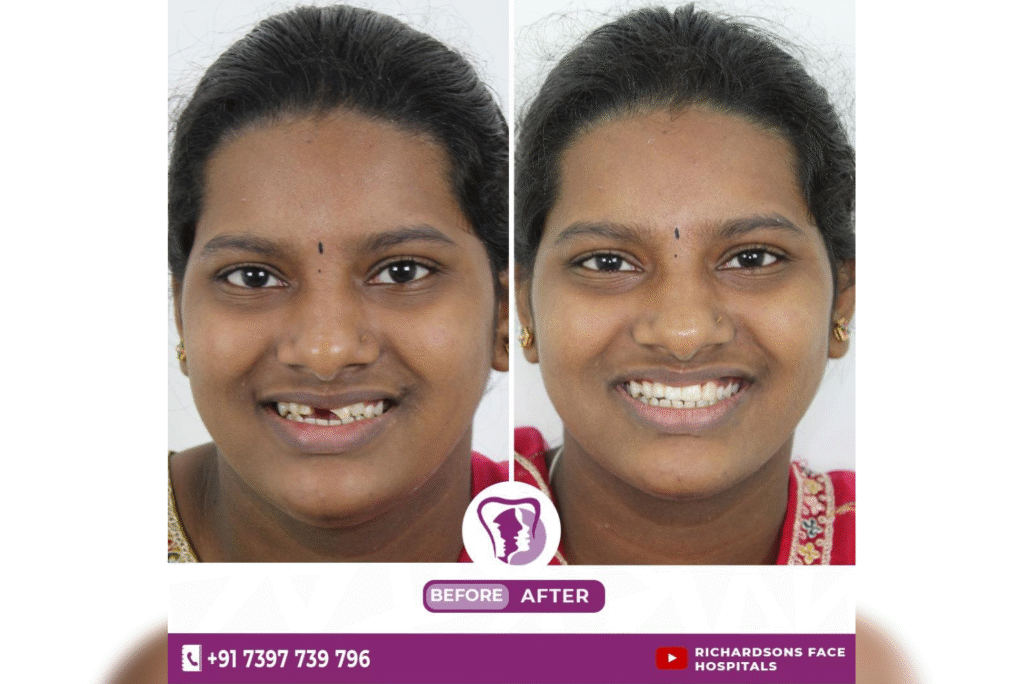 Best Smile Makeover In Bangalore
