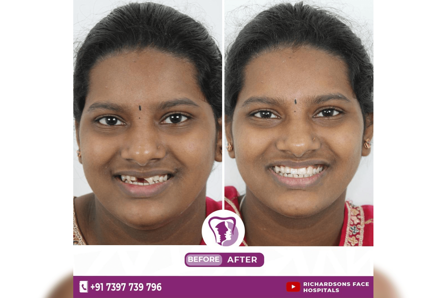 Best Smile Makeover In Bangalore